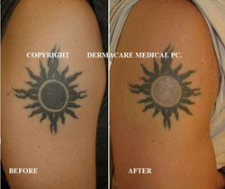 arm tattoo before and after laser removal