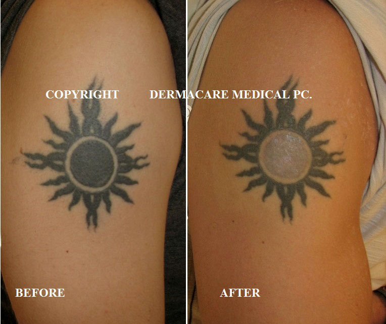 Laser Tattoo Removal - Tattoo Removal, Tattoo Laser ...